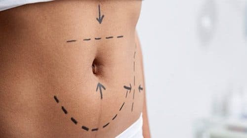 Suggestions for Tummy Tuck Surgery