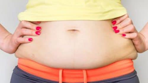 Recovery period for full Tummy Tuck